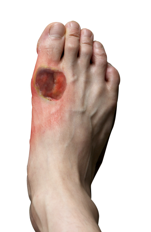 diabetic-foot